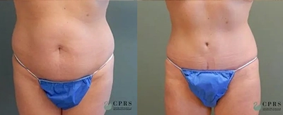 MOMMYMAKEOVER_1_Peters Florida Society of Plastic Surgeons